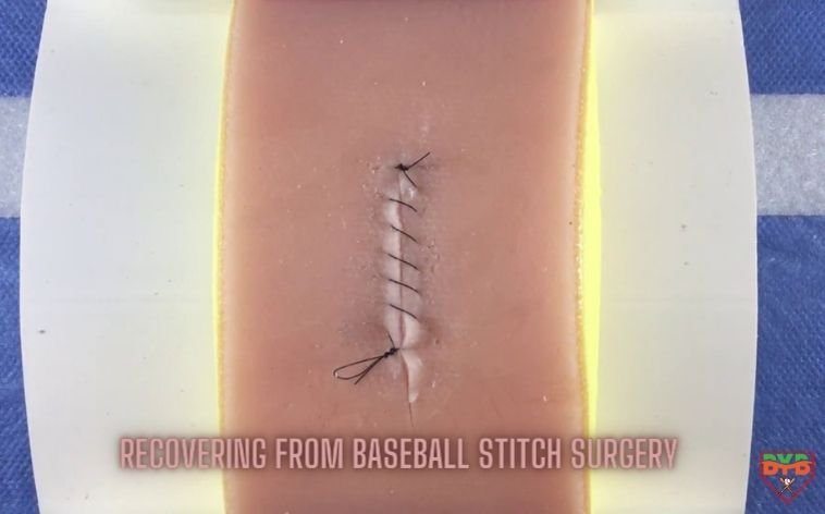 RECOVERING FROM BASEBALL STITCH SURGERY